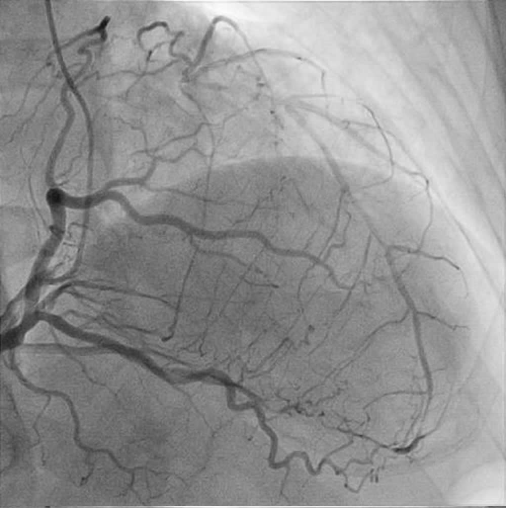 図６　右冠動脈造影検査にて逆行性に左冠動脈前下降枝が造影されている