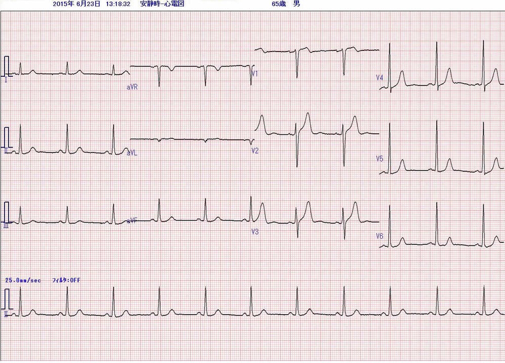 図１　当院受診時の心電図
