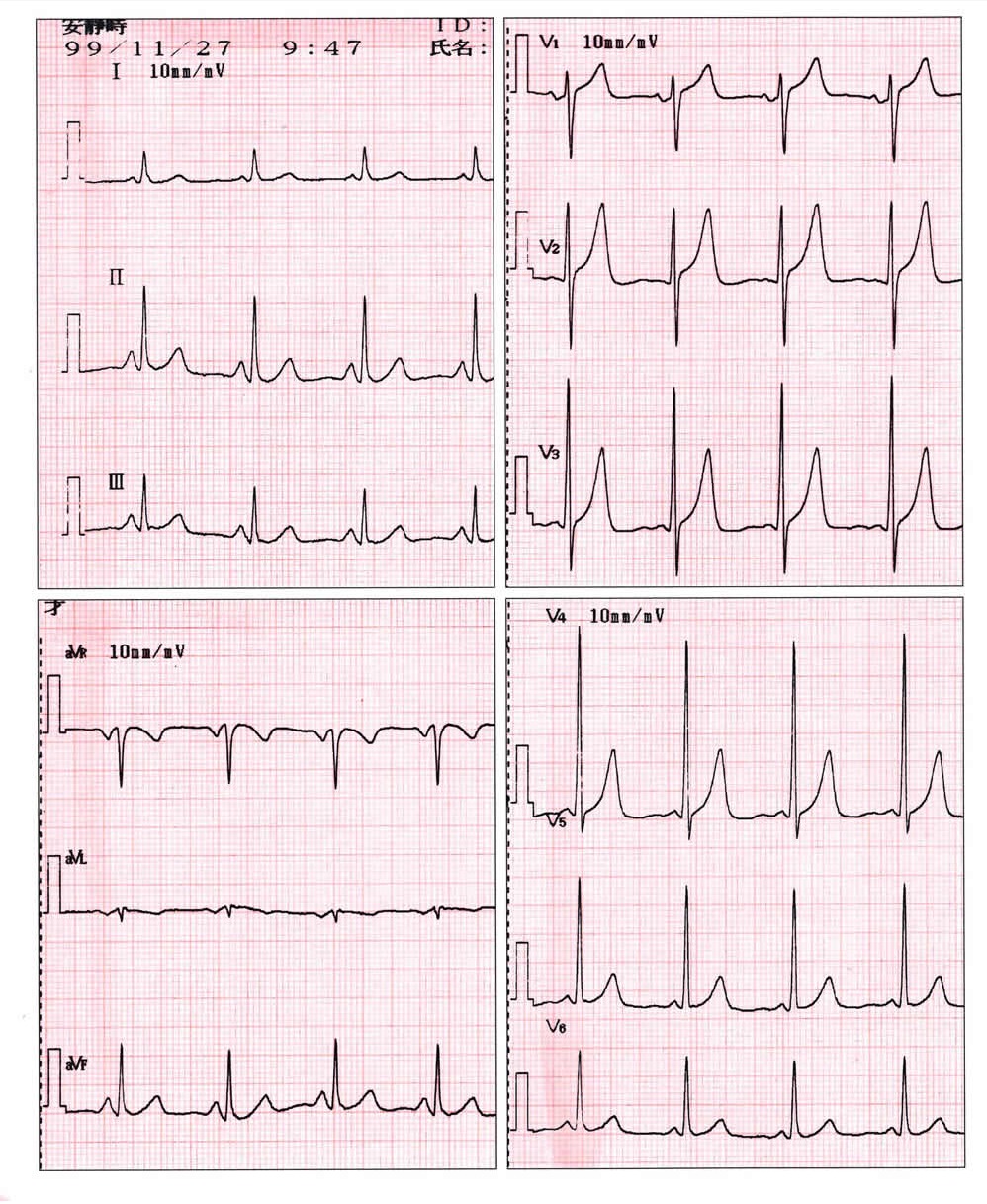 心電図１
