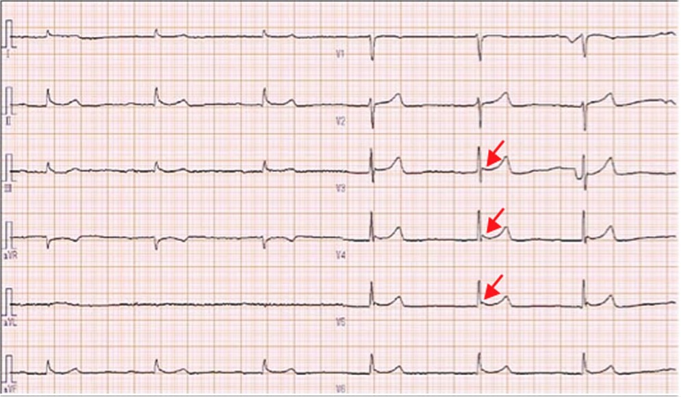 受診時の心電図（図２と同じもの　矢印はJ波を示す）