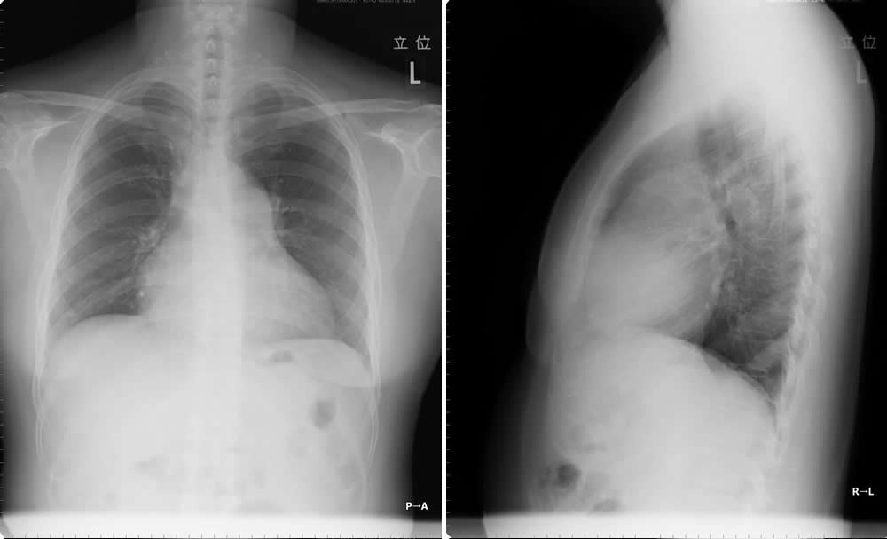 胸部X線（正面像aと左側面像b）  