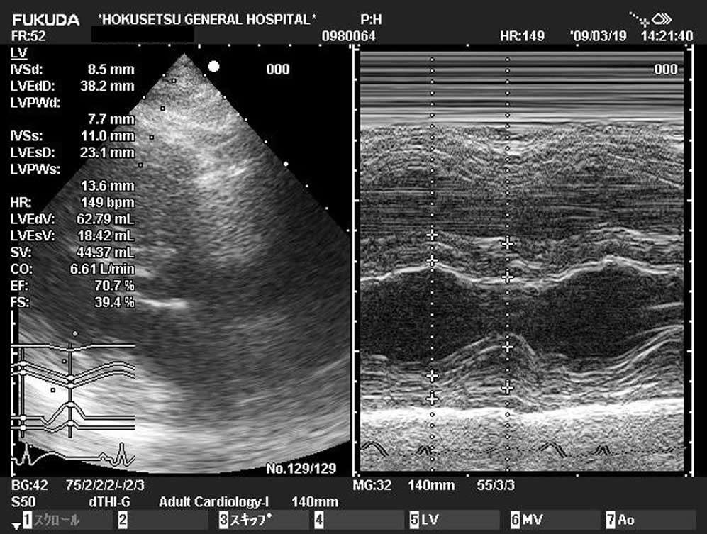 図3　心エコー図  