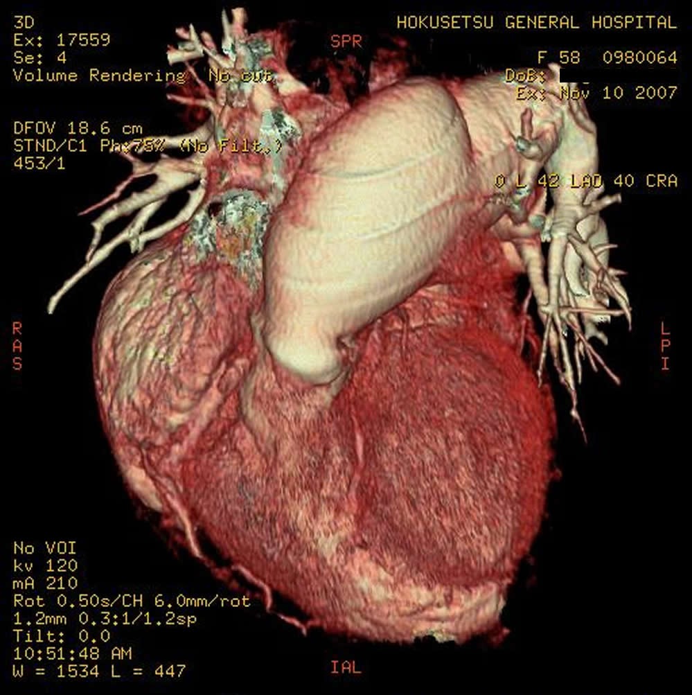 図4　著明に拡大した肺動脈幹