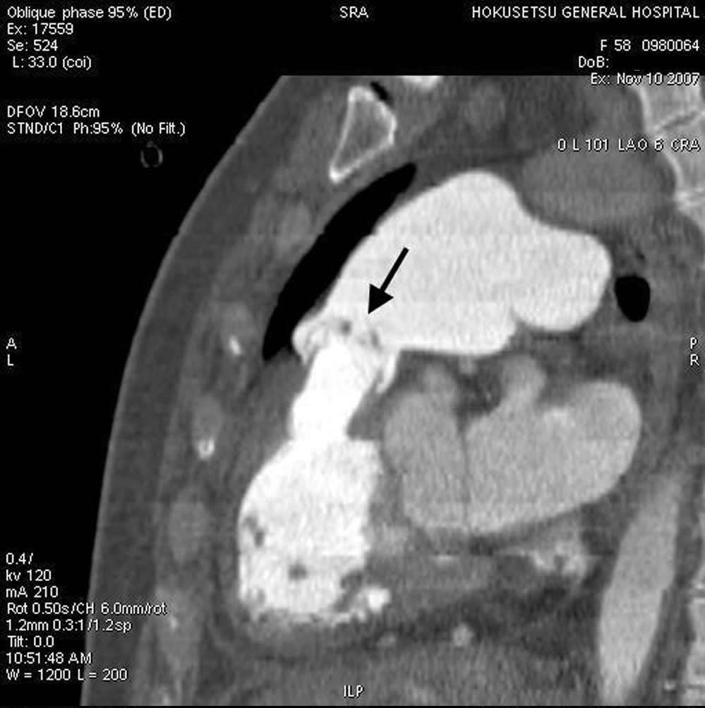 図4-b 肥厚した肺動脈弁（矢印）と右室流出路における右室壁の肥厚  