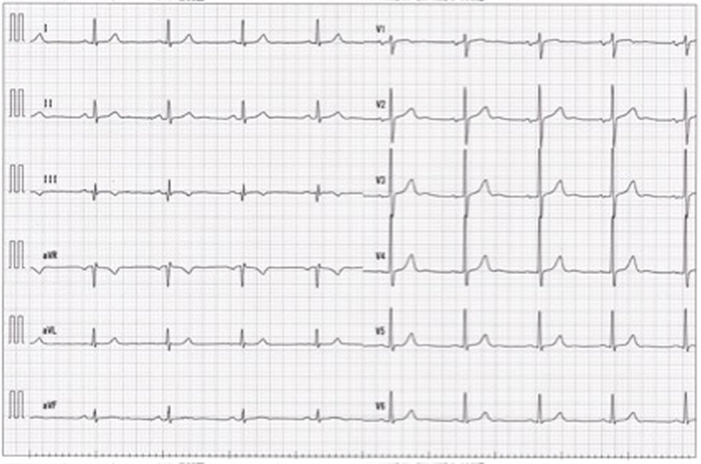 図３　退院時心電図