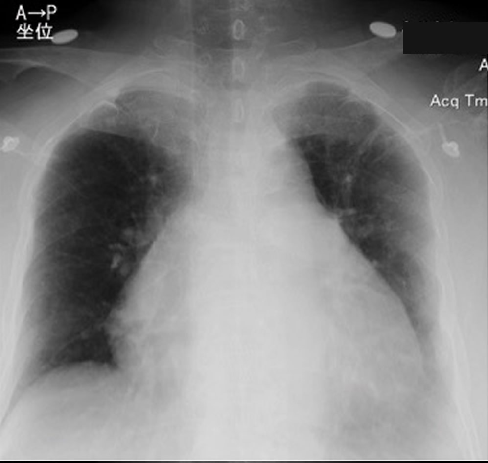 図１　入院時胸部レントゲン写真