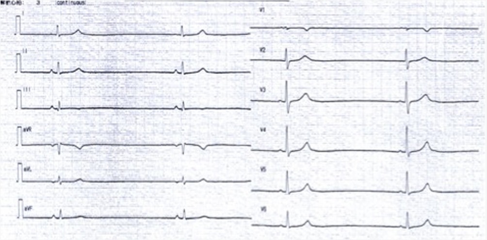 図２　入院時の心電図