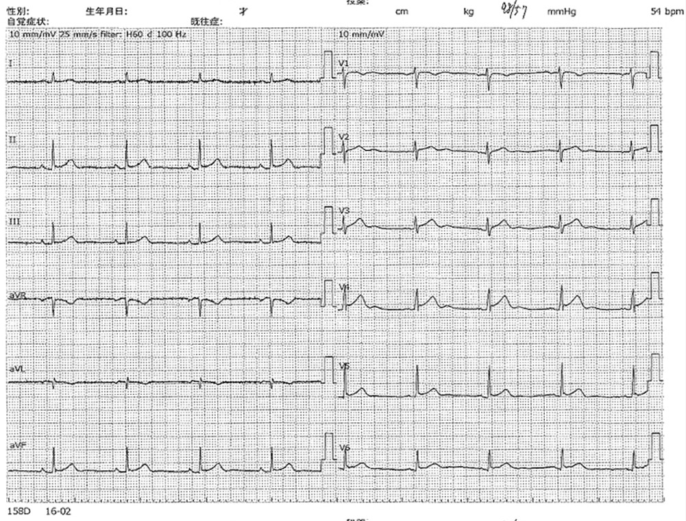 心電図3