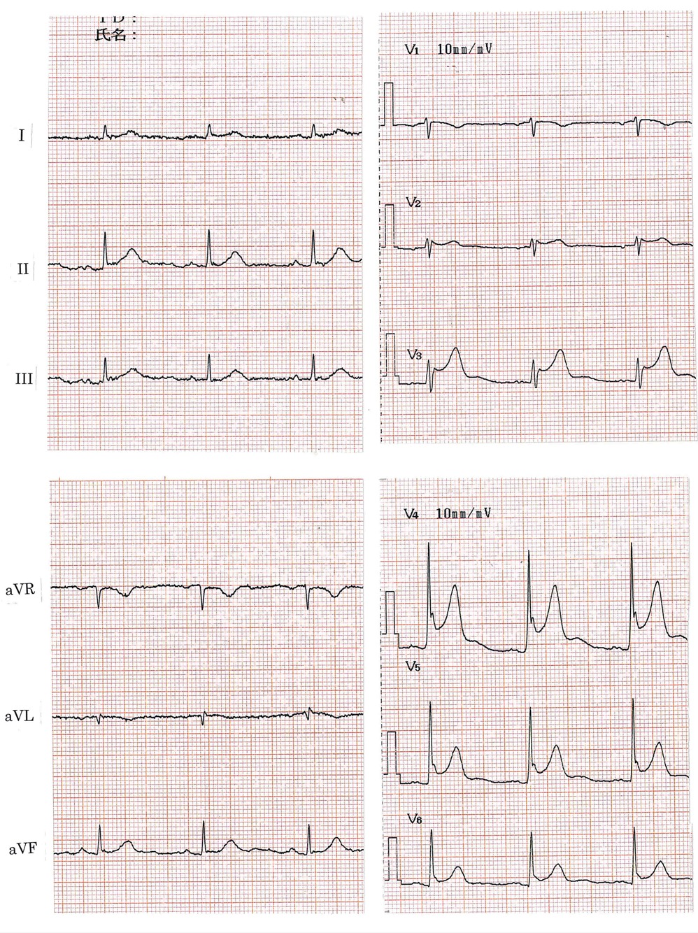 心電図１
