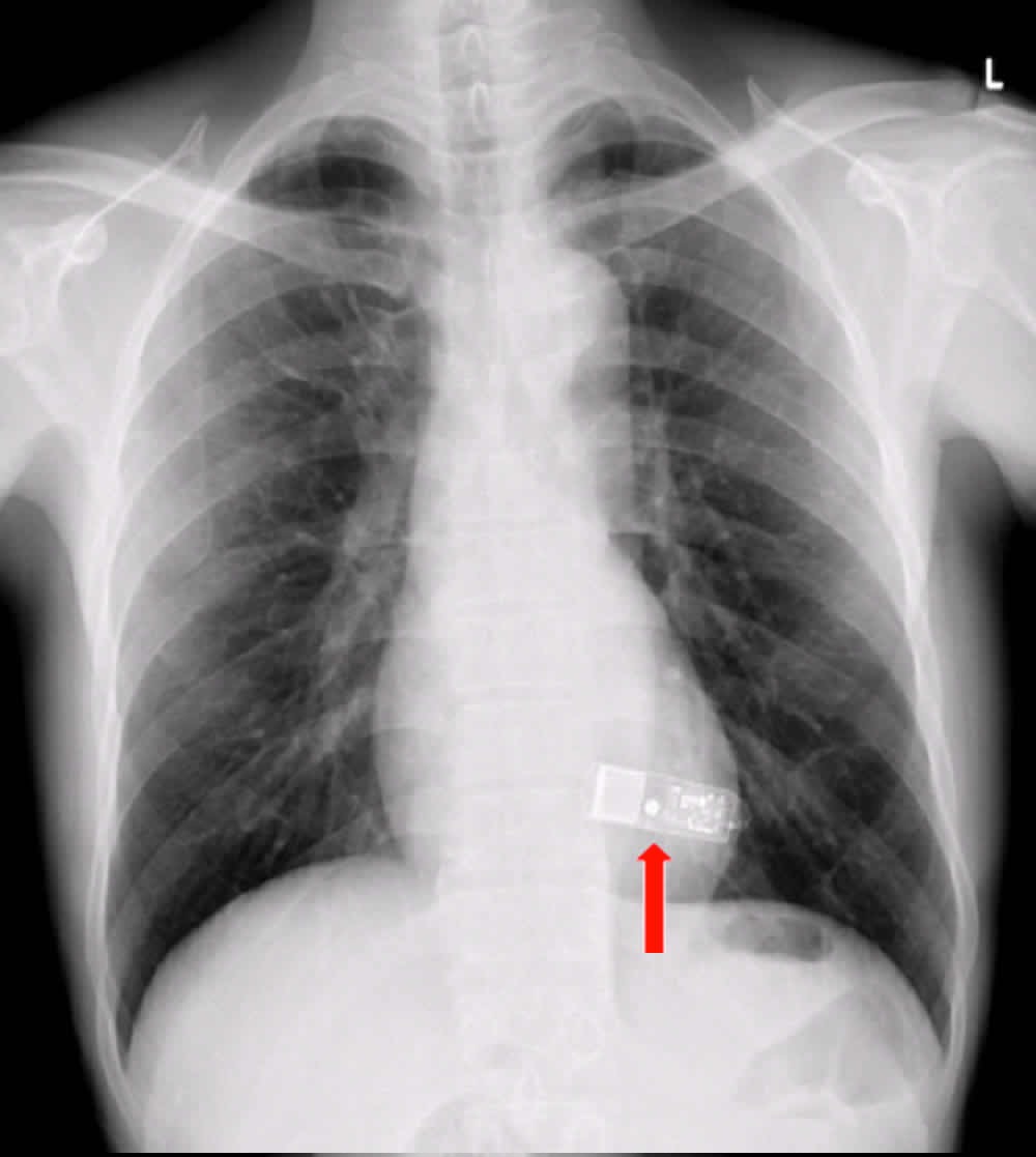 図３　植え込み型ループレコーダ植え込み術後の胸部X線写真
